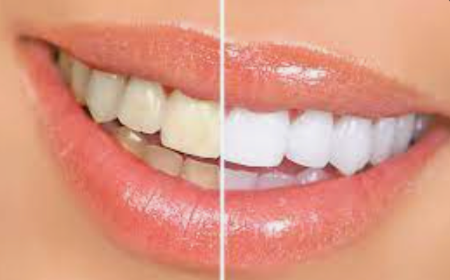 Professional teeth whitening options