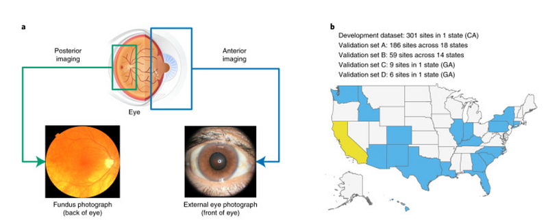 Diabetes-related complications visible through eye examination.