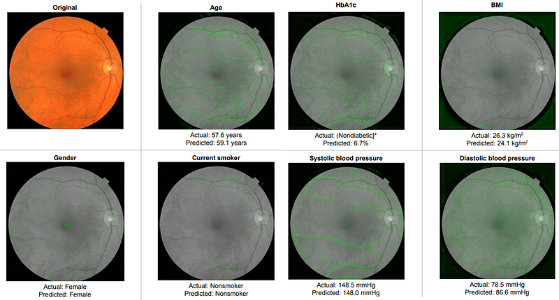 Retinal image sample indicating cardiovascular health predictions.